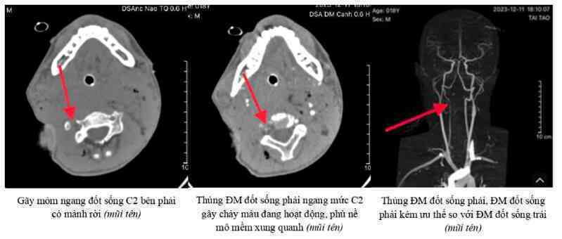 Nam sinh 18 tuổi bị bạn cùng trường đâm nguy kịch sau trận bóng