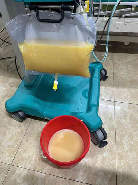 Huyết tương trắng đục như sữa do nghiện rượu