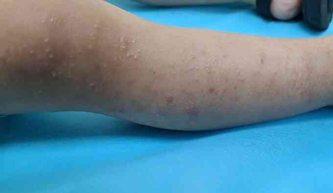 Tưởng viêm da hóa nhiễm giun sán