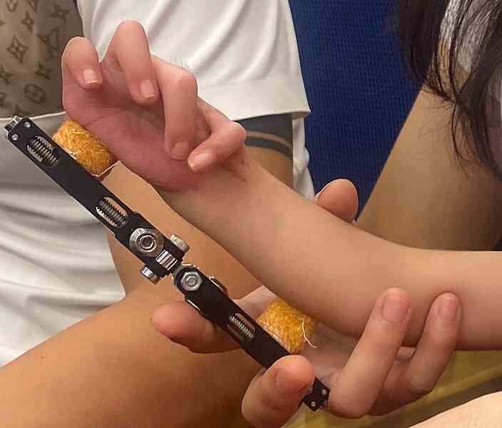 Cứu bàn tay quặt ngang như chữ L cho bé gái 4 tuổi