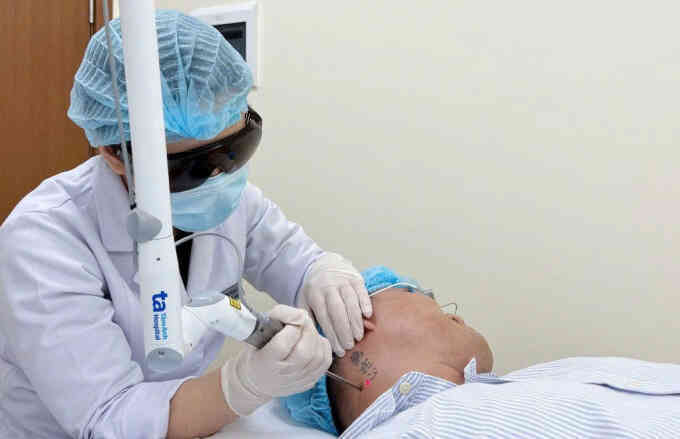 Thắc mắc thường gặp về xóa xăm bằng laser
