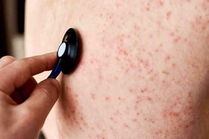 Ba nhóm nguy cơ cao nhiễm sởi