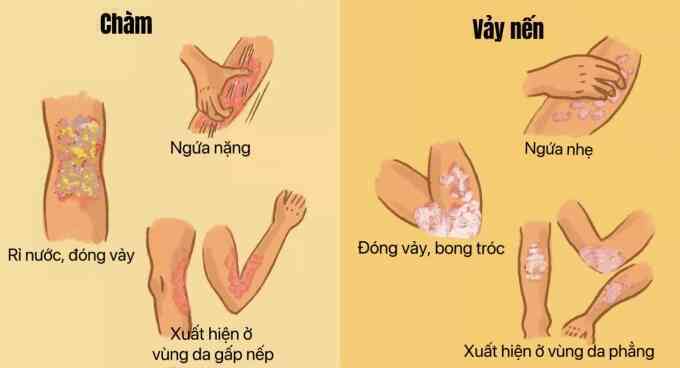 Chàm và vảy nến khác nhau thế nào