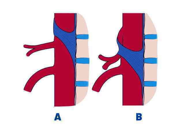 Tưởng bệnh dạ dày hóa hội chứng dây chằng cung giữa