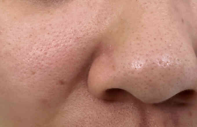 Phương pháp nào se khít lỗ chân lông to?