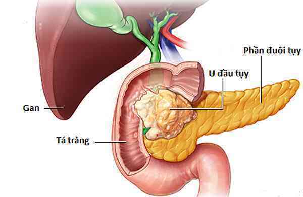 Ung thư tụy âm thầm khó phát hiện