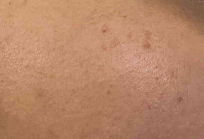 Tàn nhang khác nám thế nào