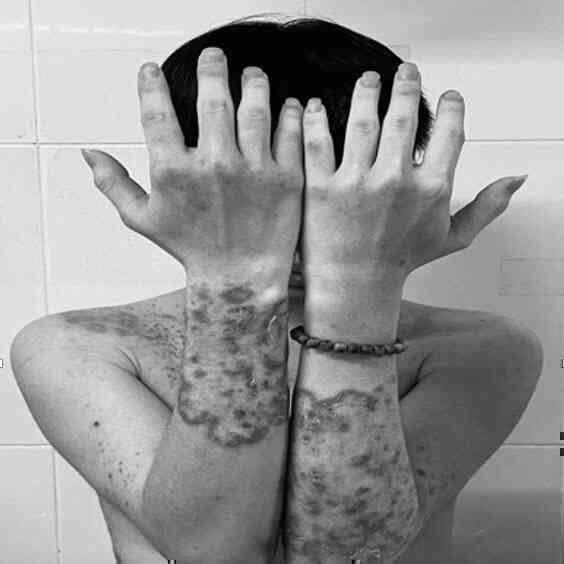 Nấm mọc toàn thân do tự điều trị mẩn ngứa