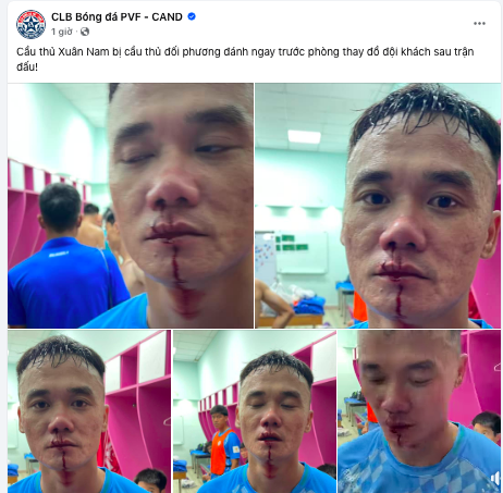 Cầu thủ đội hạng Nhất tố bị đánh chảy máu bên trong sân Thống Nhất