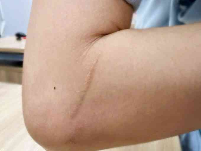 Xóa sẹo lồi bằng laser có hết không?