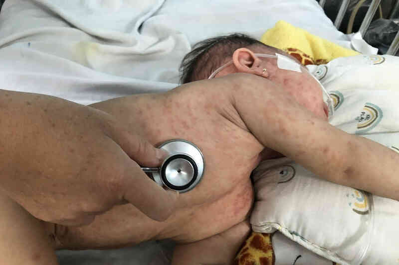 Đồng Nai ghi nhận ca tử vong đầu tiên do bệnh sởi