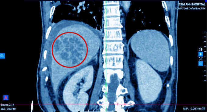 Sán lá gan nhỏ bội nhiễm E.coli tạo ổ áp xe trong gan