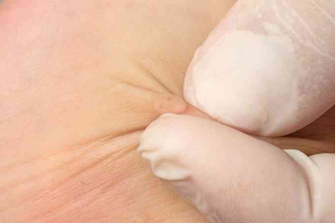 Mắc sùi mào gà ở tuổi vị thành niên