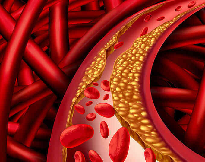 Dấu hiệu ở chân cảnh báo cholesterol cao