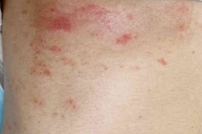 Cách giảm ngứa do vảy nến