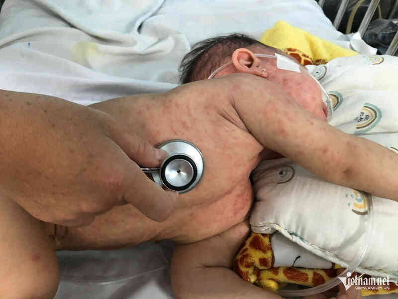 TPHCM được tiêm vắc xin sởi cho trẻ dưới 9 tháng tuổi