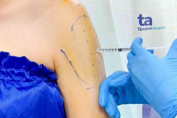 Tiêm botox an toàn không và hiệu quả bao lâu?