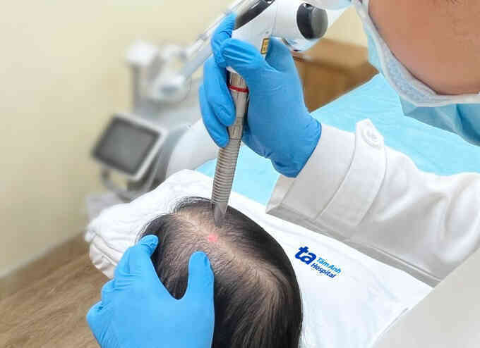Điều trị rụng tóc bằng laser