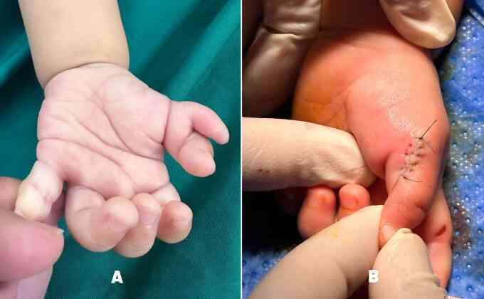 Trẻ dị tật thừa ngón nên phẫu thuật trước một tuổi