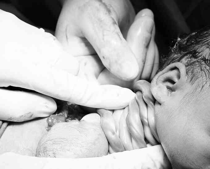 Bé gái chào đời với dây rốn quấn 9 vòng cổ
