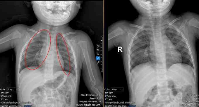 Bé trai hai lần viêm phổi trong một tuần