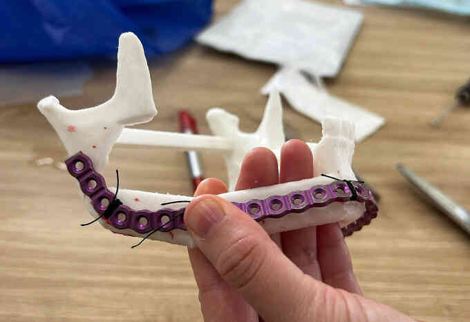 Bác sĩ tạo xương hàm 3D ghép cứu chàng trai