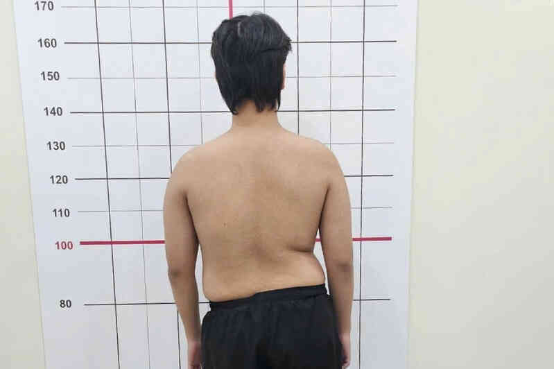 Nam sinh 19 tuổi liên tục nâng tạ 200kg bất ngờ phát hiện cột sống cong 50 độ