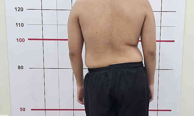 Vẹo cột sống do nâng tạ nặng 200 kg