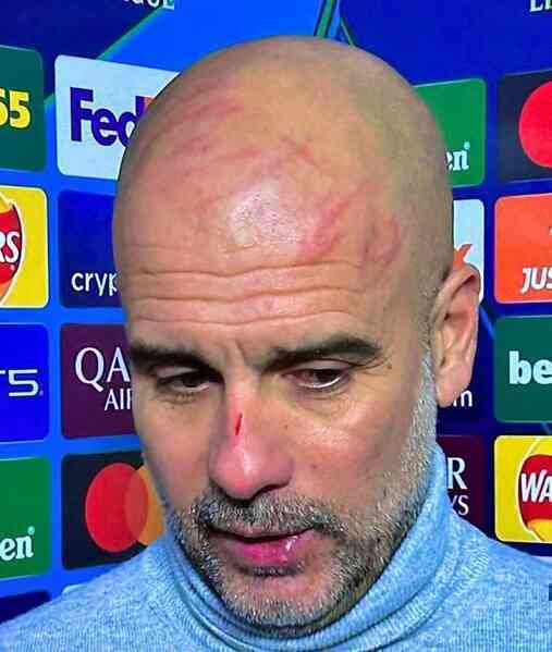 Vì sao Guardiola có nhiều vết xước trên mặt?