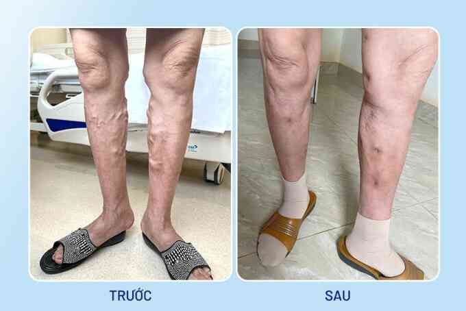 Huyết khối chân sau 20 năm không chữa suy giãn tĩnh mạch