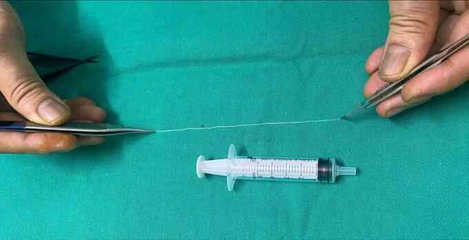 Giun 14 cm sống trong mắt người phụ nữ