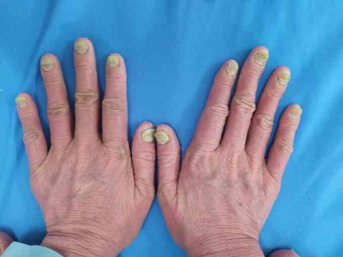 Liệu pháp ánh sáng điều trị vảy nến