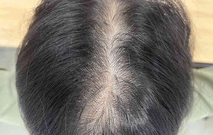 9 bệnh có thể gây béo phì