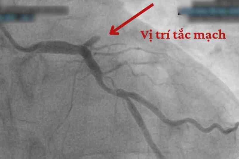 Vì sao biến cố tim mạch gia tăng vào mùa lạnh?
