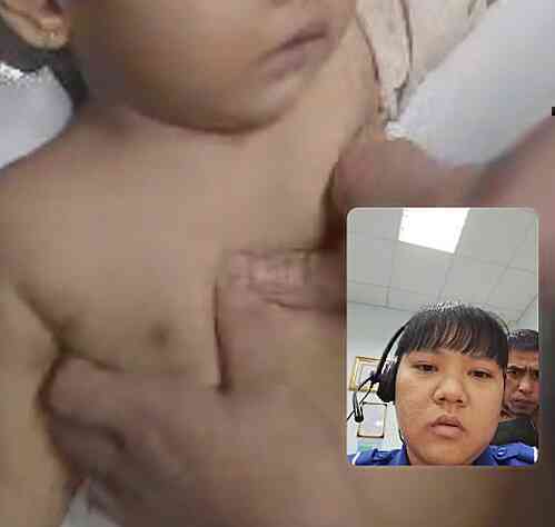 Bé gái hóc cháo được cứu sống nhờ hướng dẫn ép tim qua điện thoại