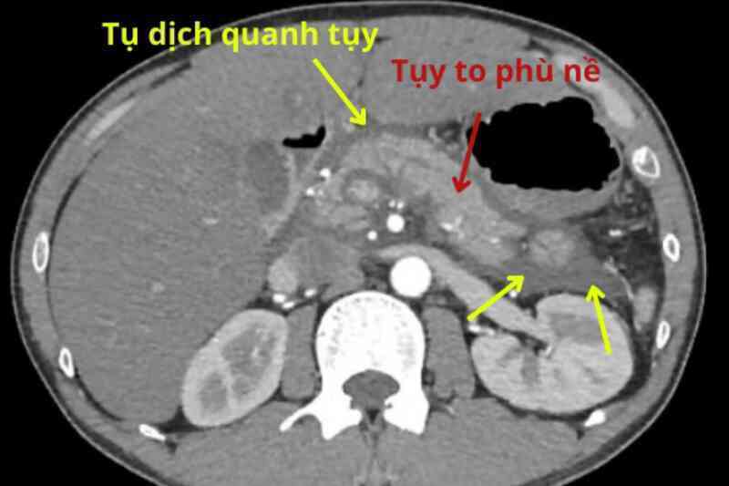 Thanh niên nguy kịch, phải lọc máu: Cảnh giác việc nhậu nhẹt dịp lễ, Tết