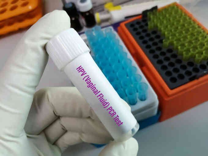 Mắc HPV có gây ra sùi mào gà?