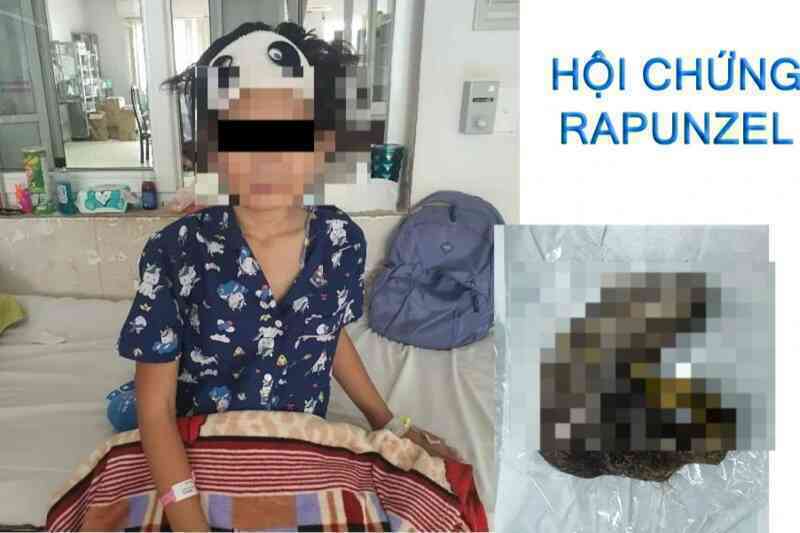 Bé gái 11 tuổi mắc hội chứng hiếm gặp, ăn cả cân tóc