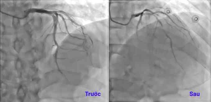 Dùng thuốc co thắt mạch vành để tìm thủ phạm gây đau ngực