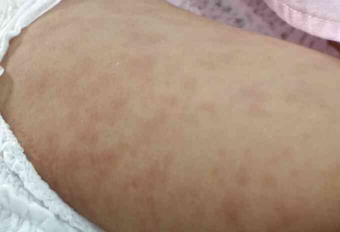 Phân biệt ban sởi và ban rubella