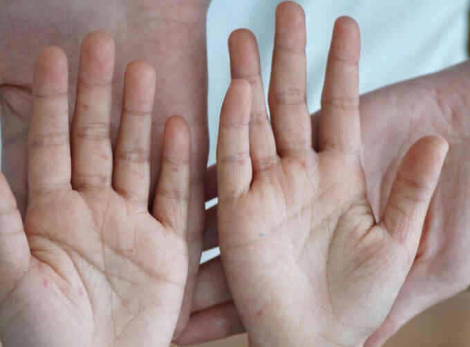 Ban sởi khác ban tay chân miệng thế nào