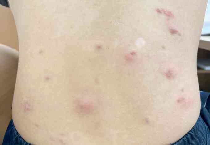 Nhiễm ký sinh trùng từ thói quen hằng ngày