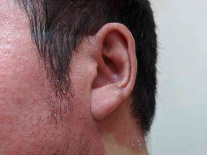 Trầm cảm do vảy nến