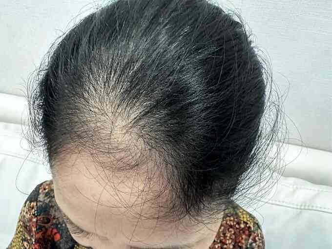 Cấy tóc chữa hói đầu như thế nào