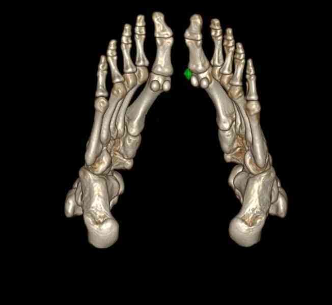 Thiếu niên 17 tuổi bệnh gout