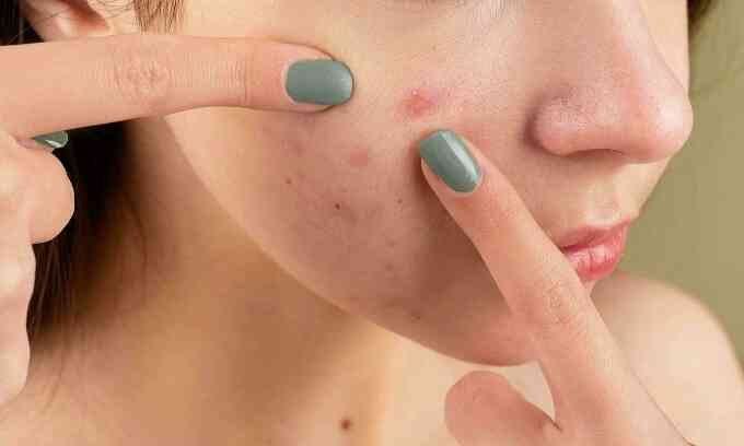 Tiền mất tật mang sau tẩy trắng da cấp tốc