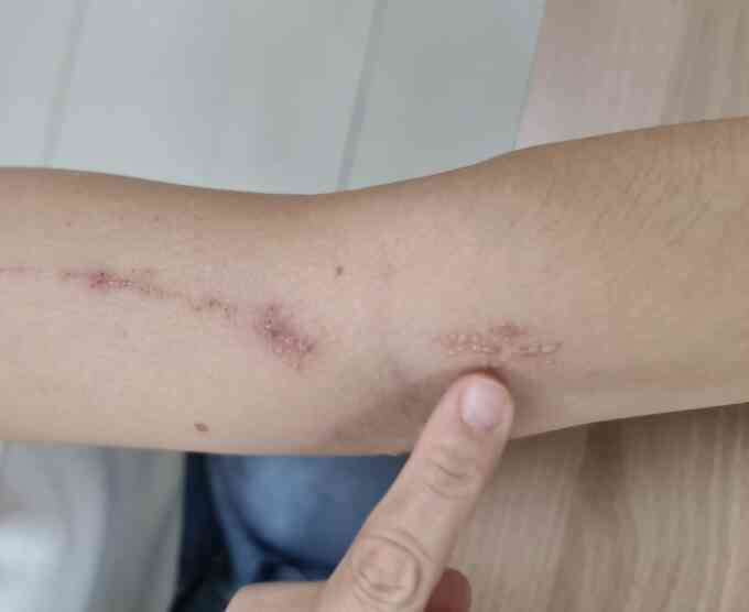 Viêm da cơ địa và tiếp xúc ở trẻ khác nhau thế nào