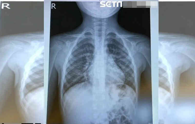 Virus HMPV tấn công Trung Quốc, bác sĩ kêu gọi làm ngay 2 việc