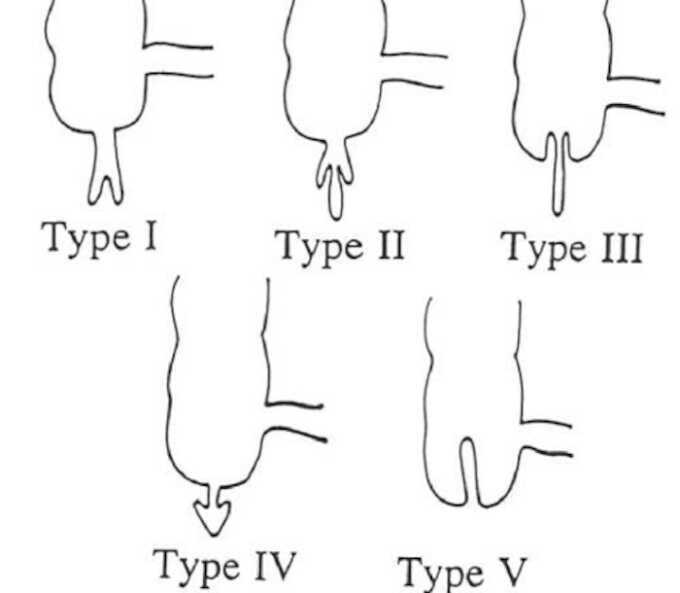 Nam thanh niên bị lồng ruột thừa