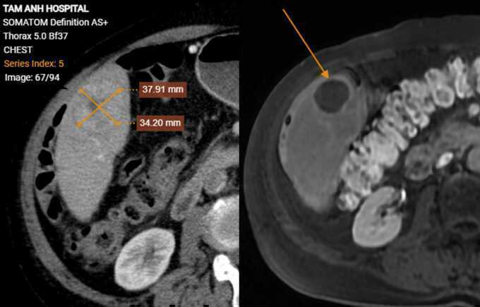 Nút mạch triệt căn hai u gan ác tính